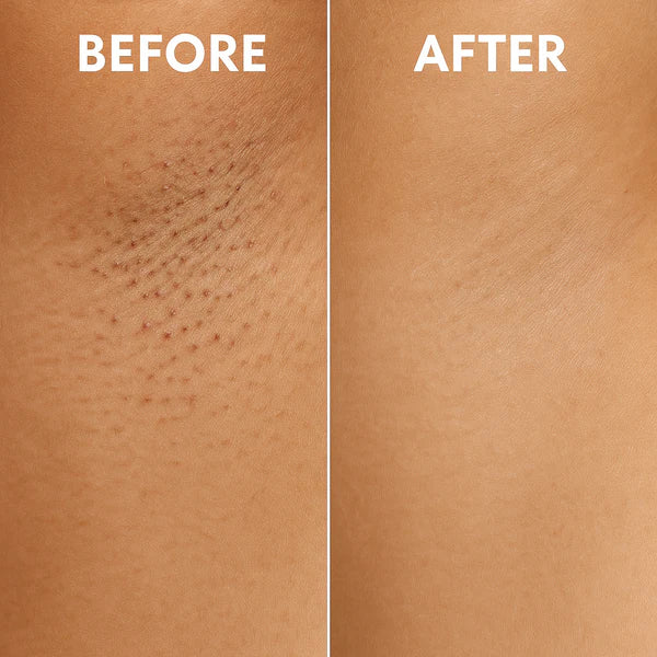 Veloura™ Ingrown Solution